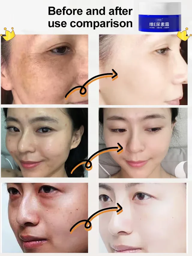 🔥BUY 1 GET 1 FREE 🔥 Spot Fading Urea Cream